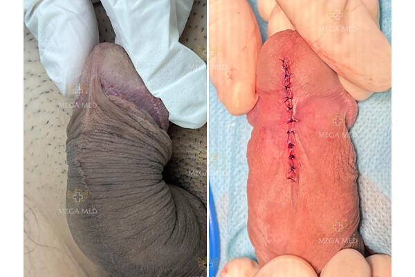 ngắn dây hãm gây căng tức khi quan hệ, cong dương vật